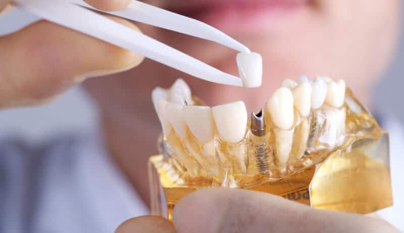 Dental Implant Brisbane, Wavell Heights, Clayfield - Sure Dental