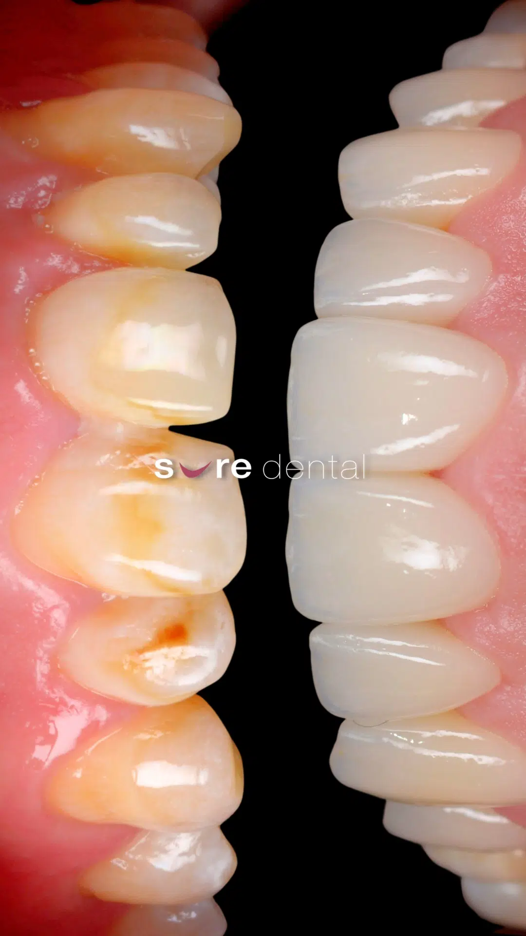 Adrian's Veneers Makeover In Sure Dental