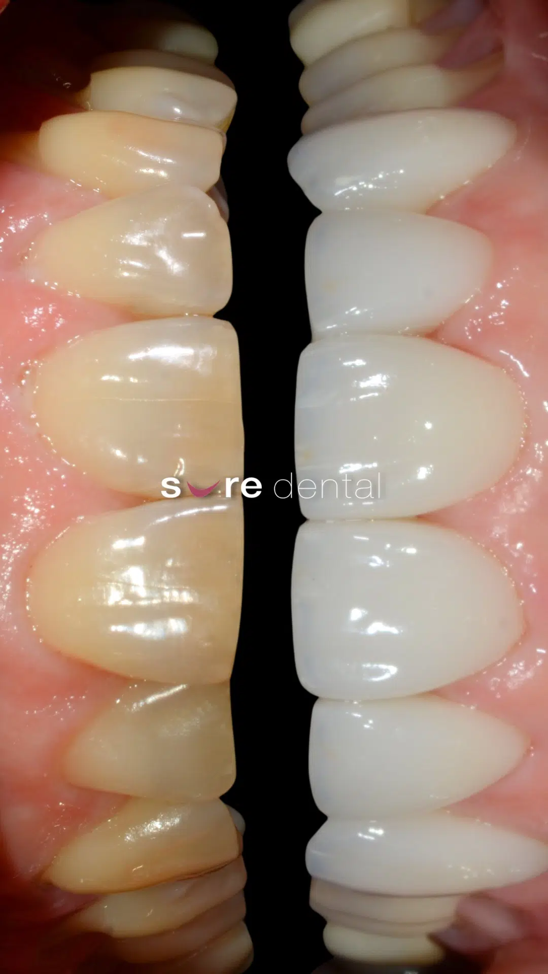 Andrea's Veneers Makeover In Sure Dental