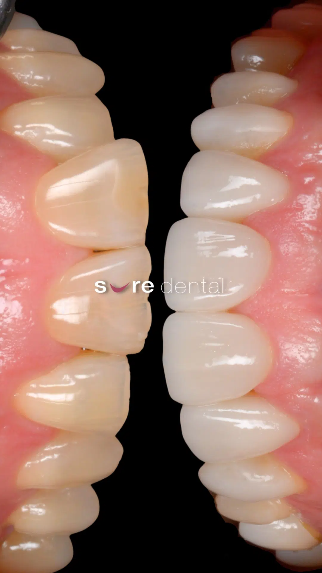 Aubrey's Veneers, Crown And Invisalign Makeover In Sure Dental