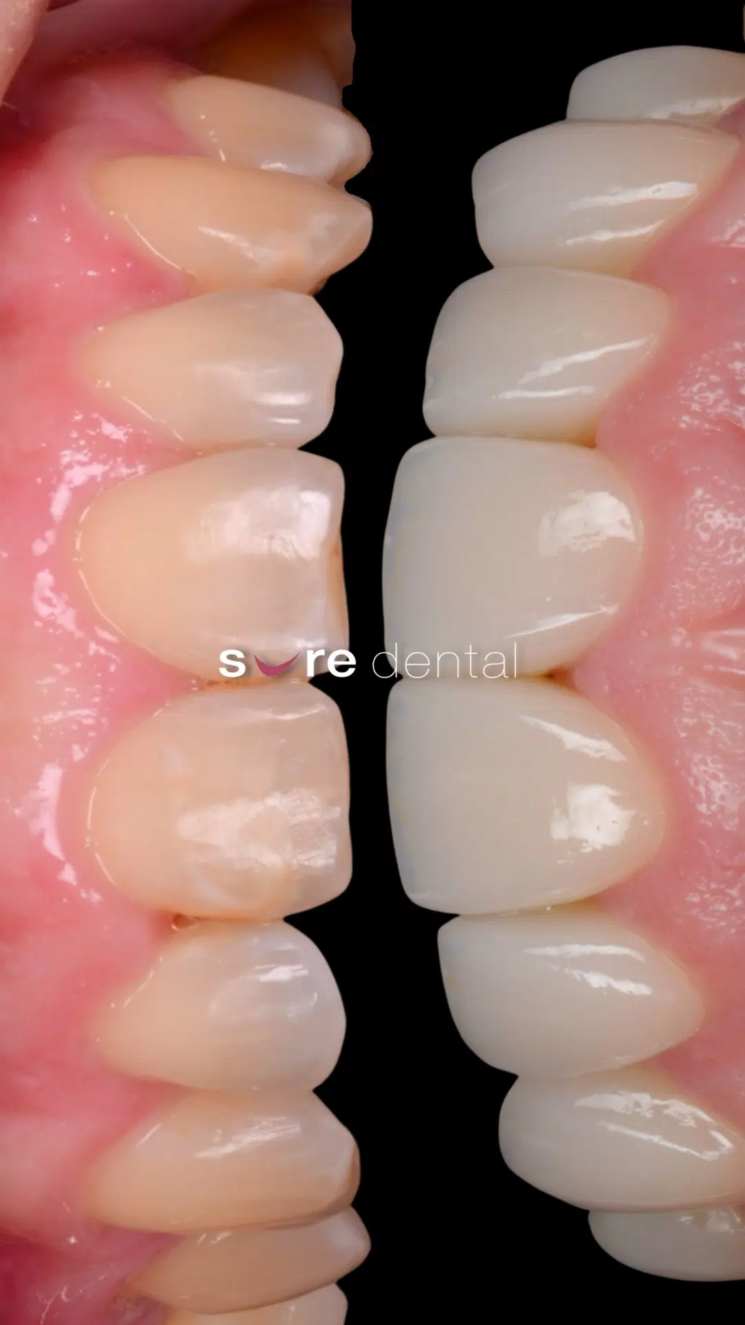 Bell's Veneers And Orthodontics Makeover In Sure Dental