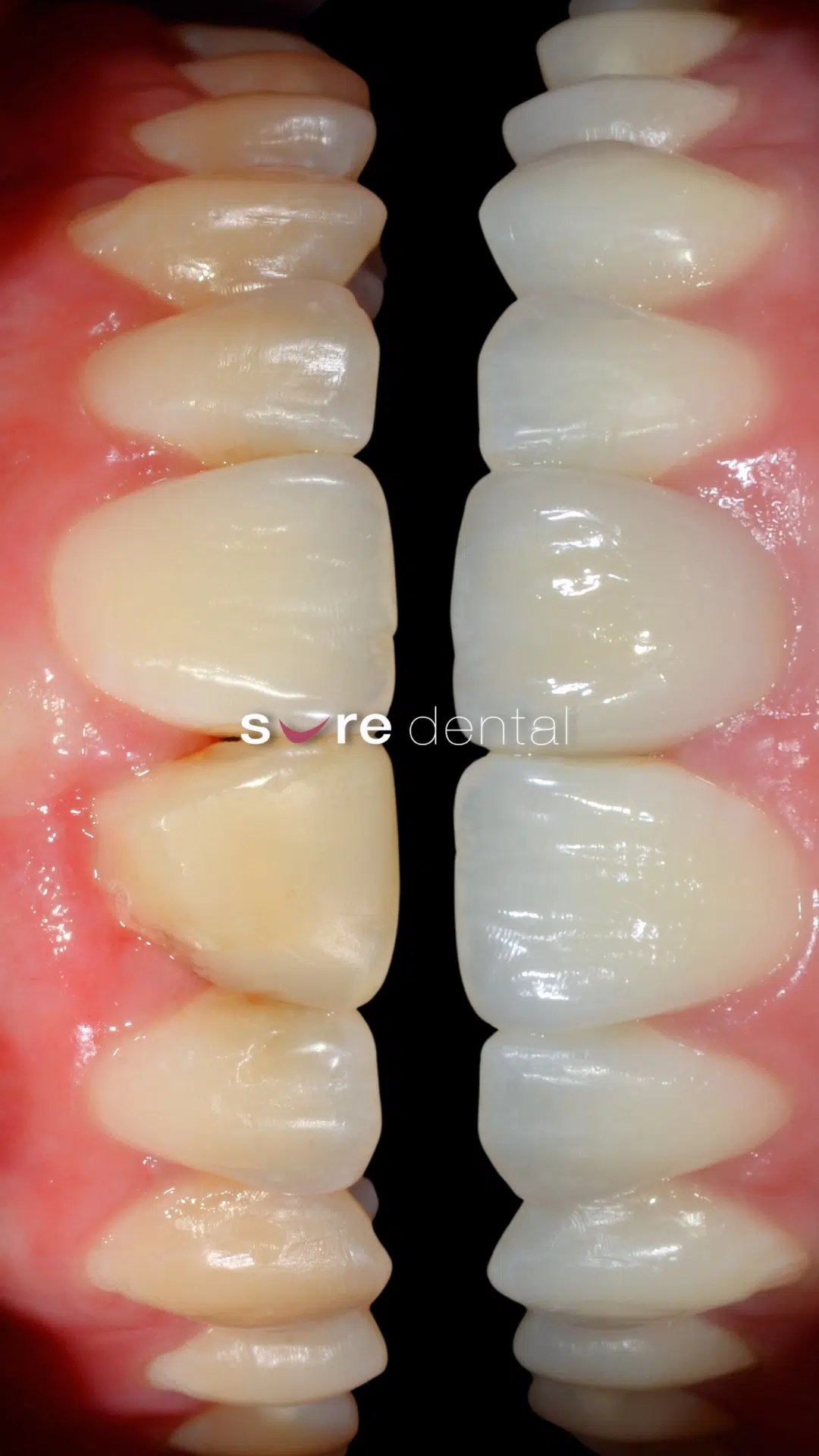 Danni's Veneers And Teeth Whitening Makeover In Sure Dental
