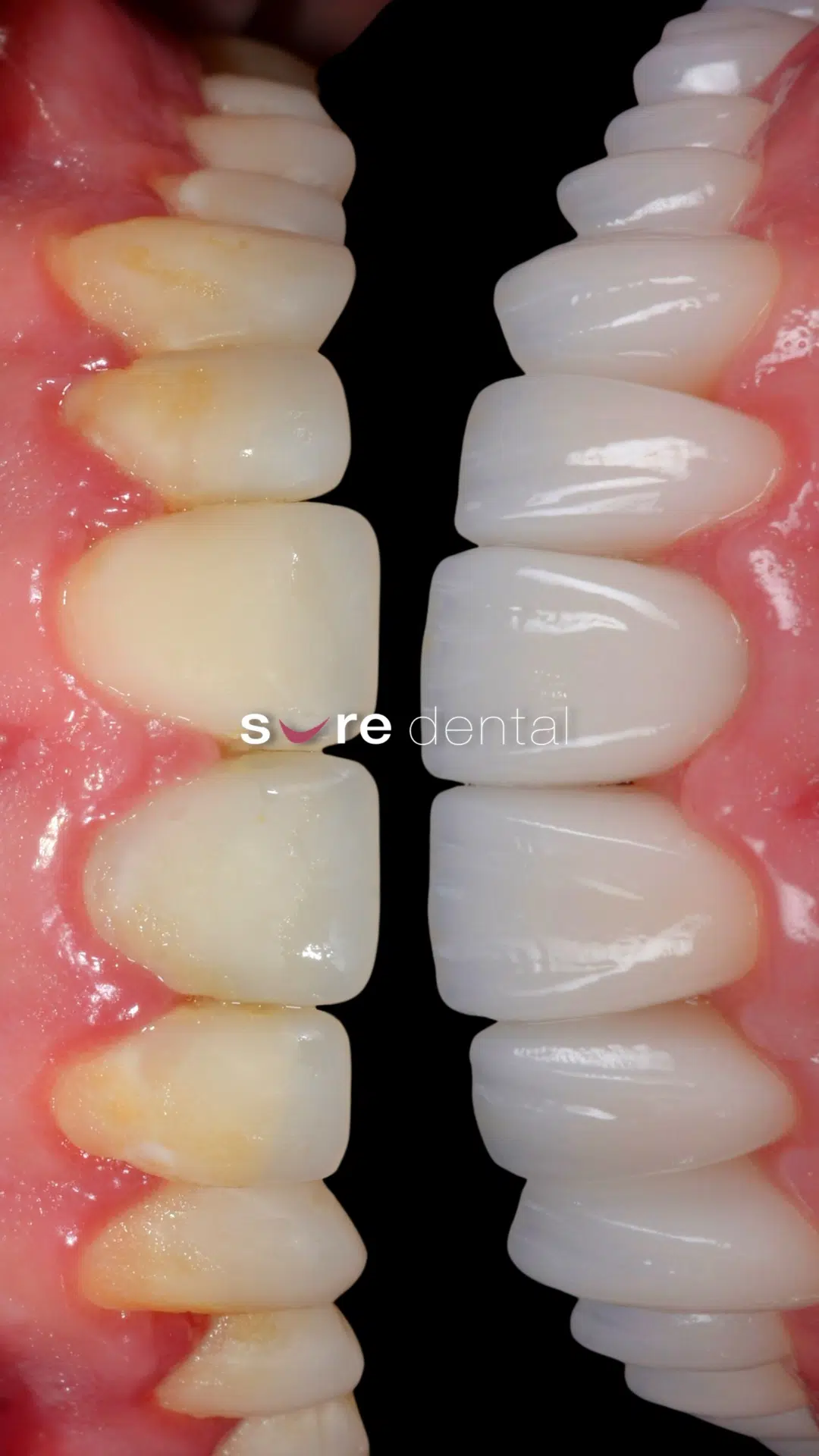 Jesse's Veneers, Teeth Whitening And Braces Makeover In Sure Dental