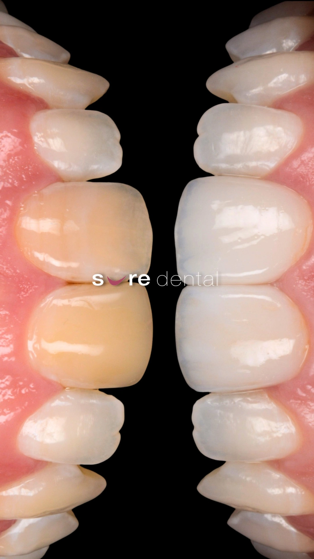 Kristen's Veneers Makeover In Sure Dental