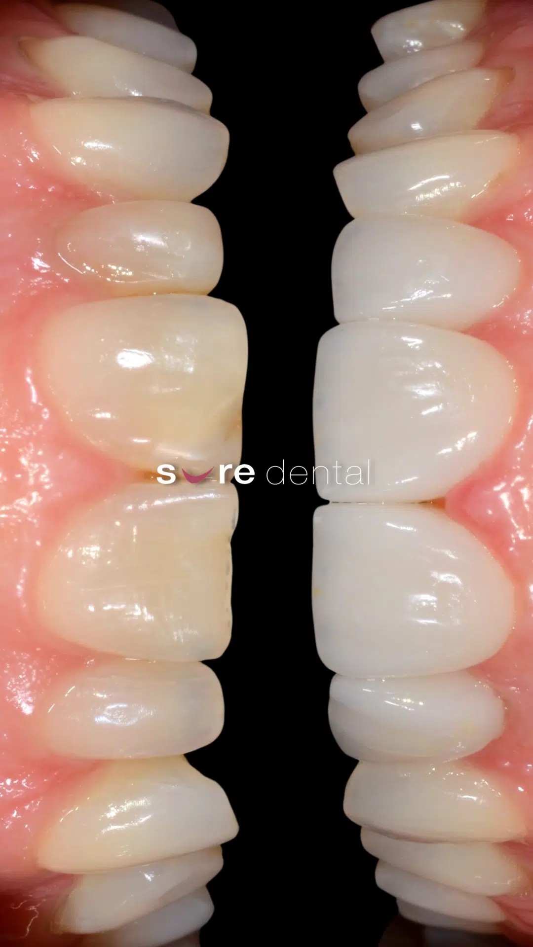 Kylie's Veneers Makeover In Sure Dental