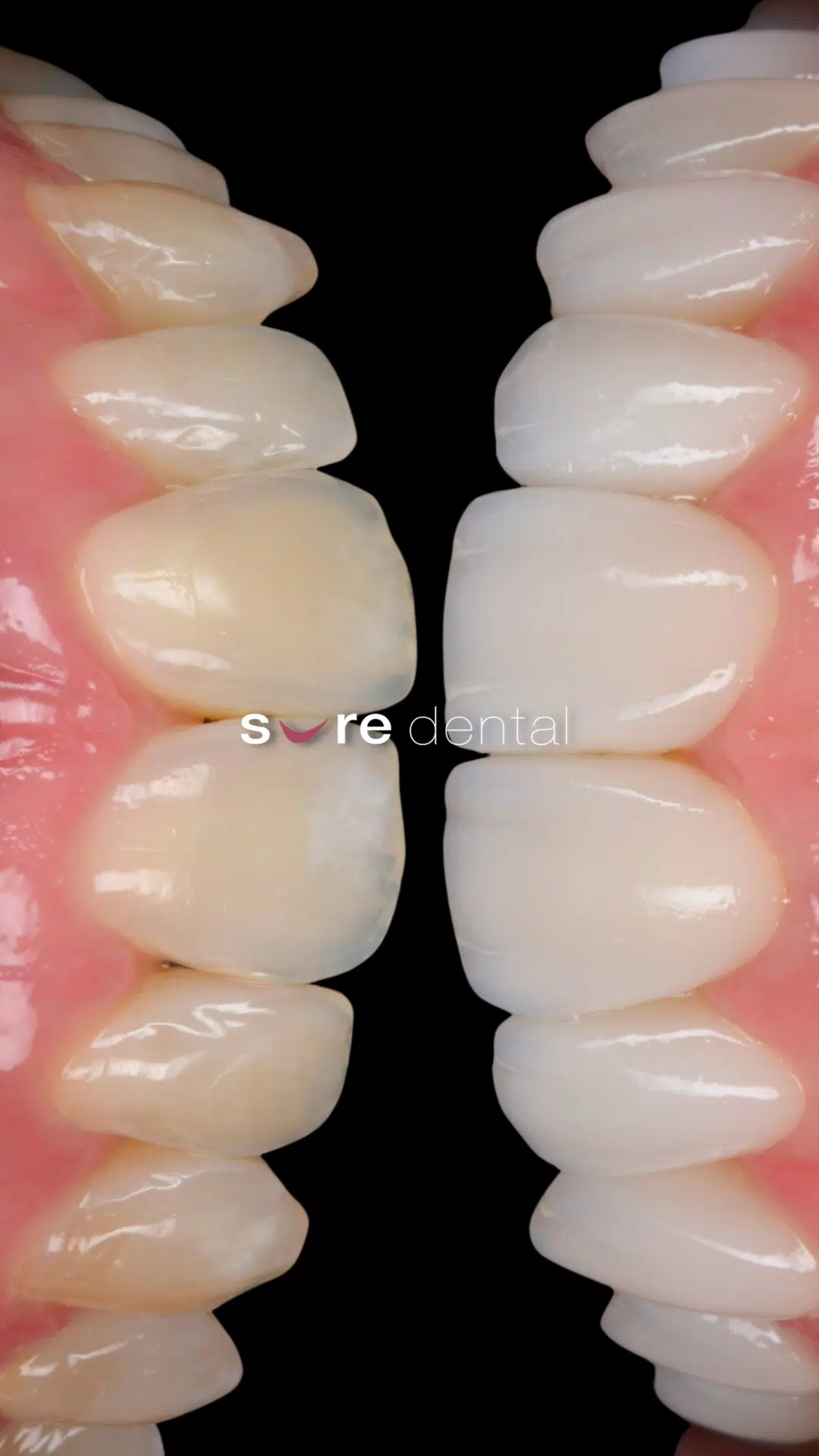Linda's Veneers And Teeth Whitening Makeover In Sure Dental