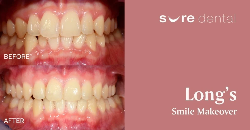 Long’s Smile Makeover In Wavell Heights