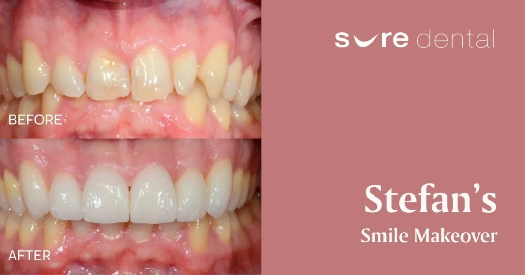 Stefan’s Porcelain Veneers & Crowns In North Brisbane