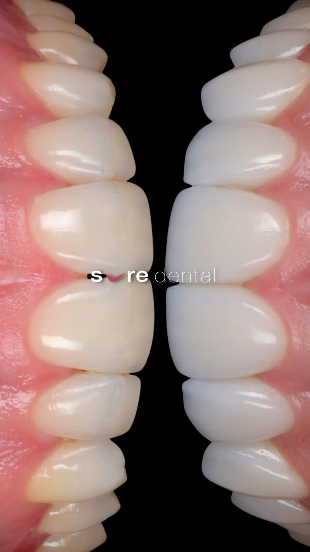 Travis Veneers And Teeth Whitening Makeover In Sure Dental